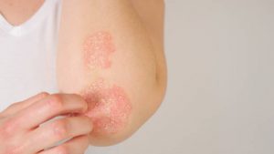 Can You Cure Eczema With Beta Gel